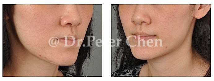 正顎-削骨-墊下巴