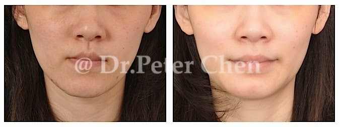 正顎-削骨-墊下巴