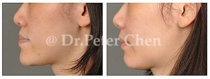 正顎-削骨-墊下巴