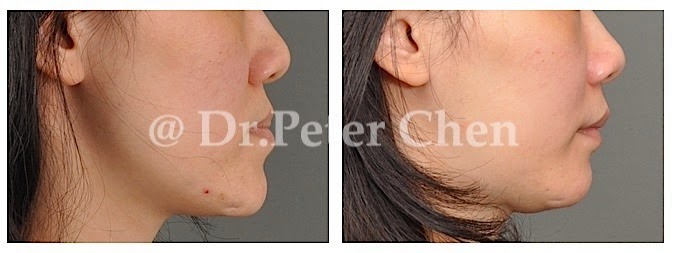 正顎-削骨-墊下巴