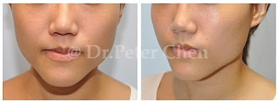 正顎手術,下巴手術