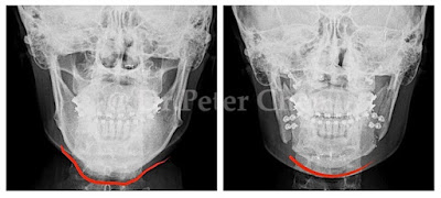 正顎手術,下巴手術