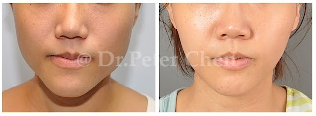 正顎手術,下巴手術