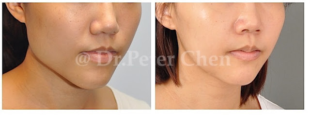 正顎手術,下巴手術