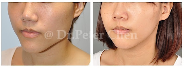 正顎手術,下巴手術