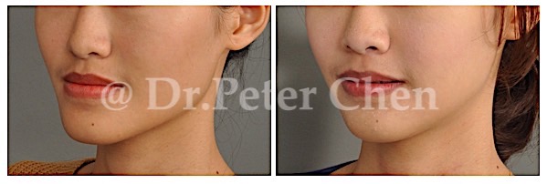 正顎,正颌,台北,新竹,凡登,陳瑞鋒醫師