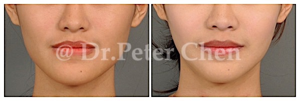 正顎,正颌,台北,新竹,凡登,陳瑞鋒醫師