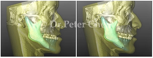 正顎手術 正顎手術