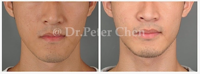 正顎手術 正顎手術