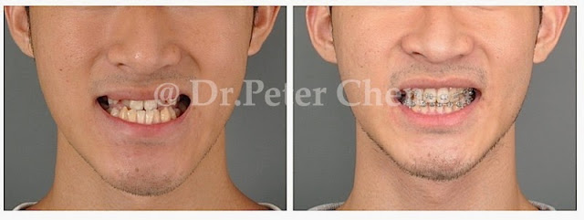 正顎手術 正顎手術