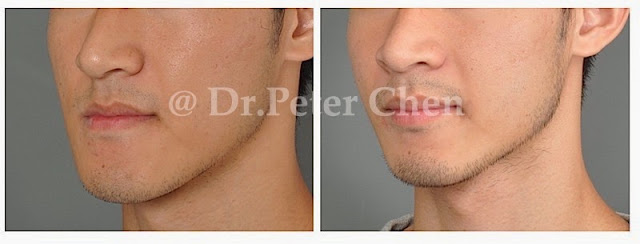 正顎手術 正顎手術