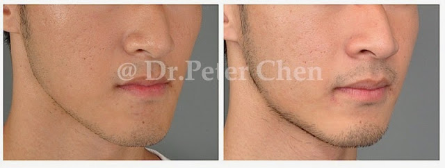 正顎手術 正顎手術