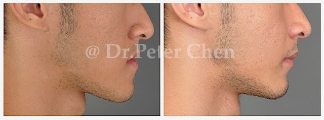 正顎手術 正顎手術